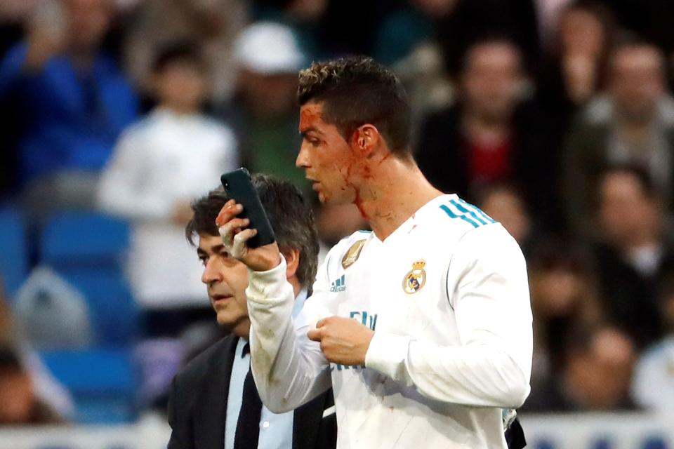 Ronaldo berkaca dari layar handphone melihat wajahnya berlumuran darah. foto:epa