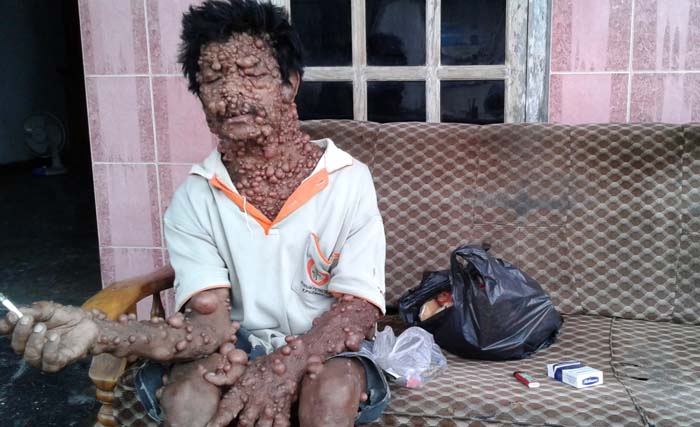 Parni, penderita Neurofibromatosis di depan rumahnya di Dusun Grintingan, Desa Lojejer Kecamatan Wuluhan Kabupaten Jember, Kamis 1 Februari 2018. (foto: ngopibareng/m. anis)