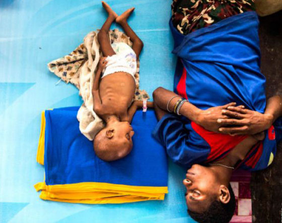 Seorang ibu bersama anaknya Amatus (3) tertidur di Aula Gereja Protestan, Agats, Kabupaten Asmat, Papua, Senin, 22 Januari 2018. Jumlah anak penderita gizi buruk dan campak yang dirawat sebanyak 85 orang diantaranya di RSUD Agats 40 anak dan 45 anak di aula gereja Protestan Indonesia. (Foto: Antara)