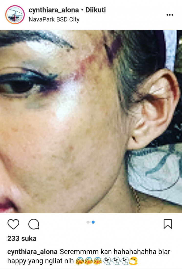 Foto wajah Cynthiara Alona usai dihajar pacar bulenya. foto: instagram cynthiara_alona.