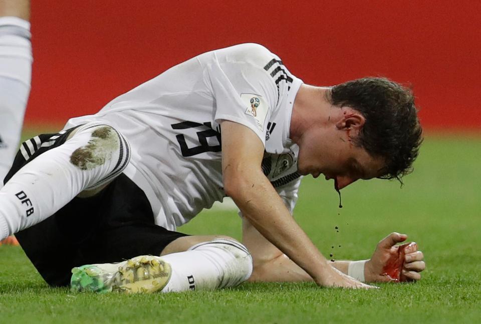 Pemain Jerman Rudy terlihat berlumuran darah saat laga melawan Swedia. foto:reuters