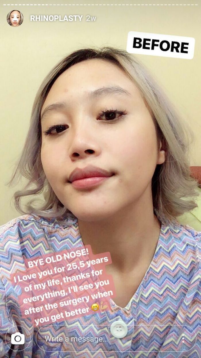 Wajah Janine Intansari sebelum oplas.