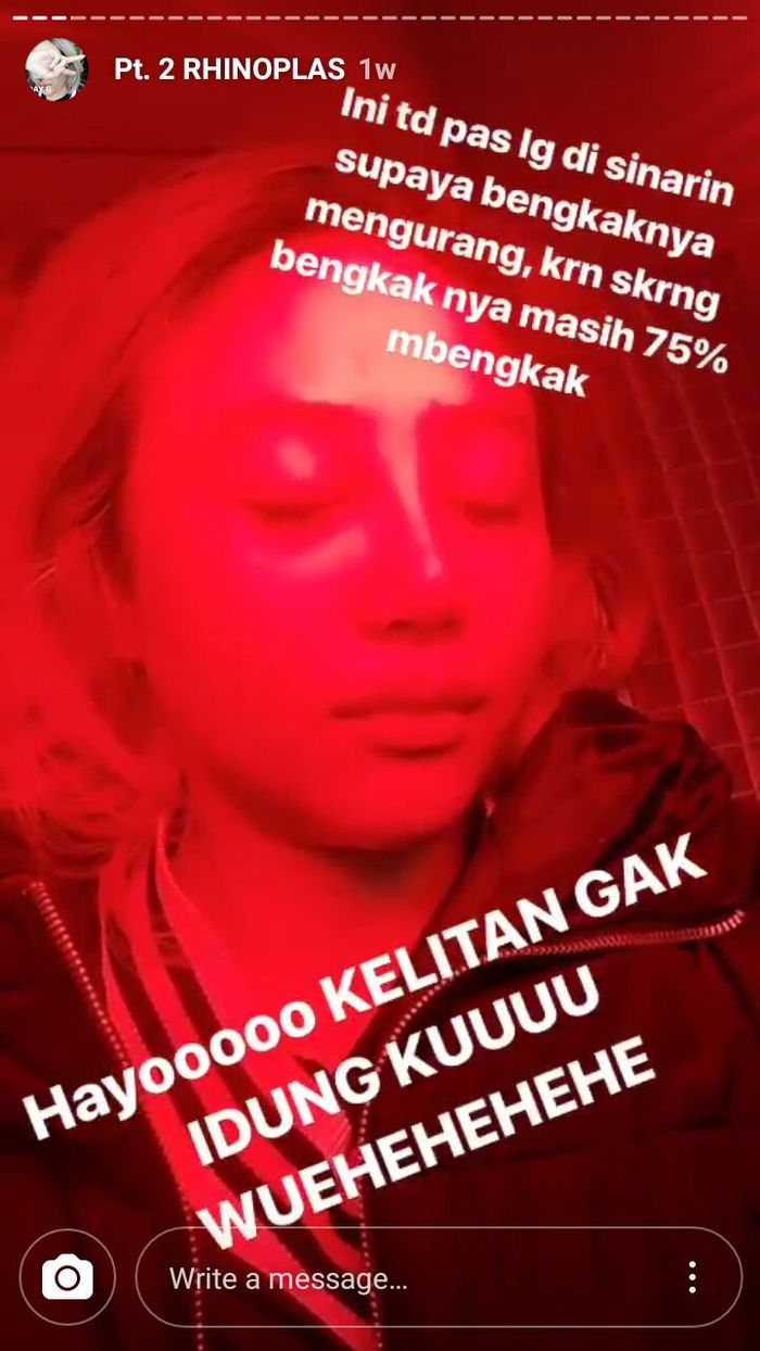 Proses penyinaran usai perban dilepas dari hidung Janine Intansari.