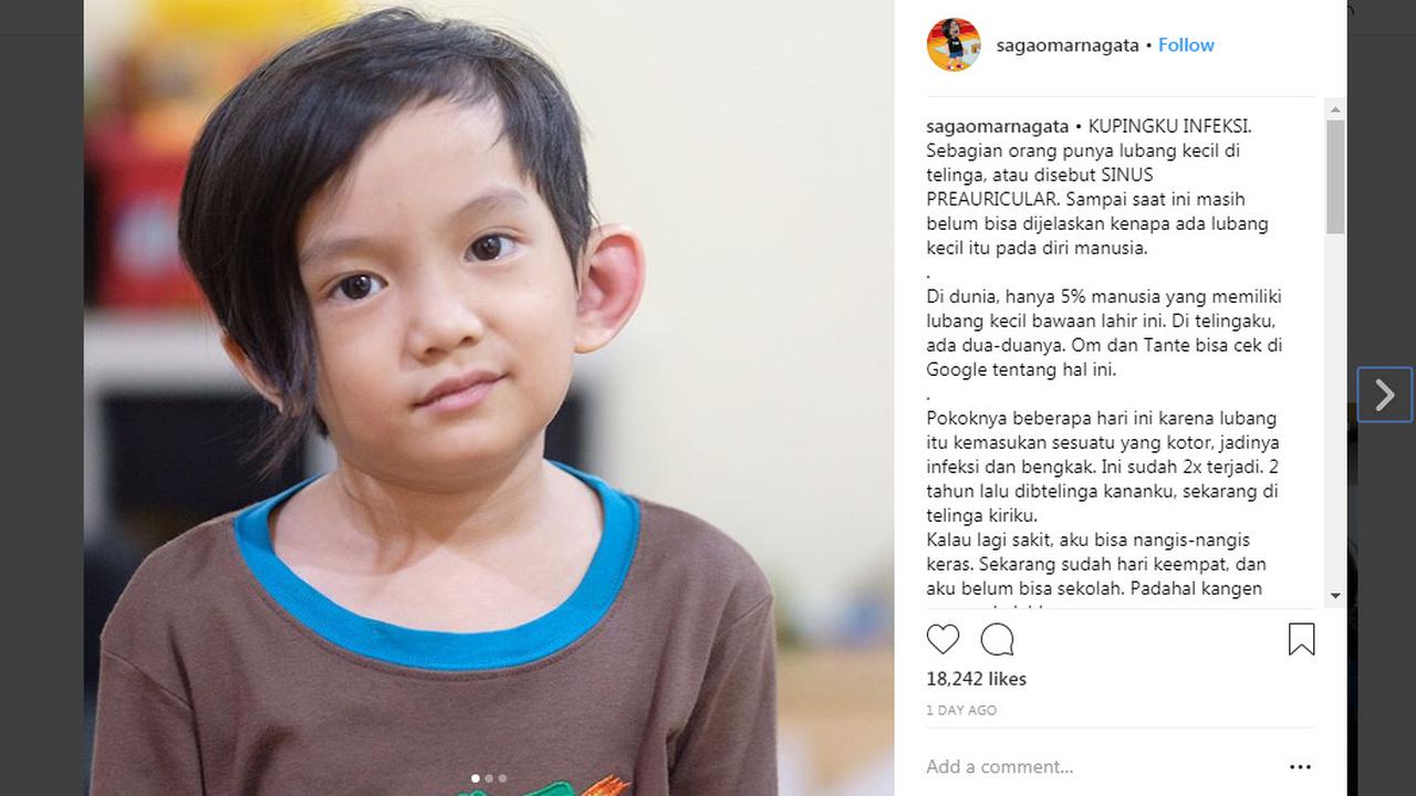 Telinga kiri Saga bengkak akibat sinus preauricular. Dua tahun lalu telinga bagian kanan yang terserang infeksi. Foti: IG/sagaomarnagata.