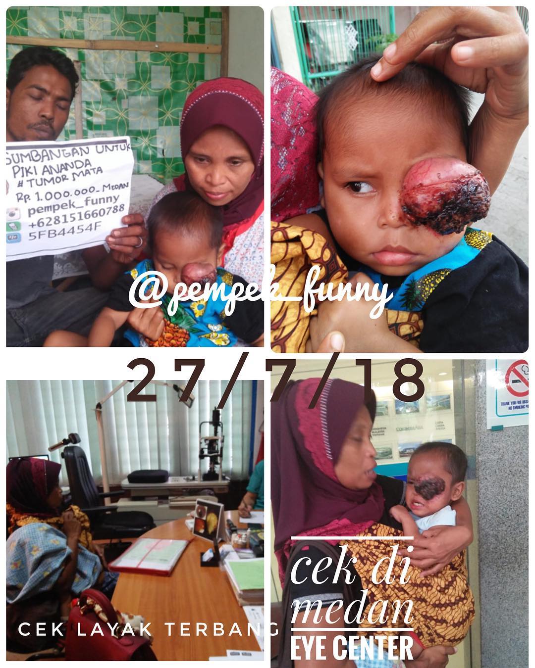 Kondisi bayi Piki Ananda (3) mengidap tumor mata.