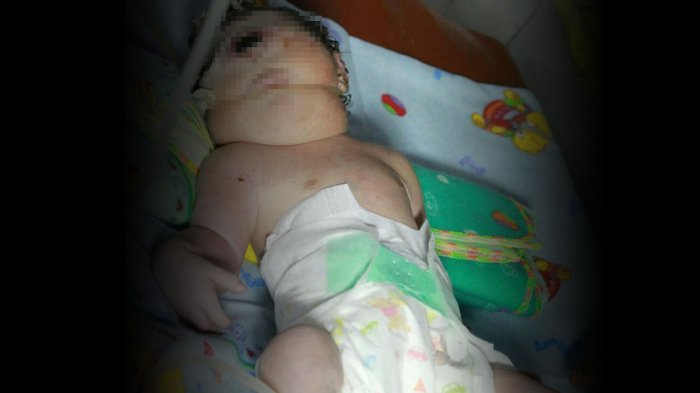 Kondisi bayi bermata satu tanpa hidung di Mandailing Natal.