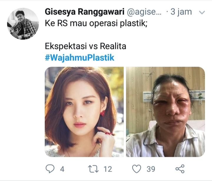 Lebam di wajah Ratna Sarumpaet disandingkan dengan foto Seo Hyun-jin (Foto:captured)