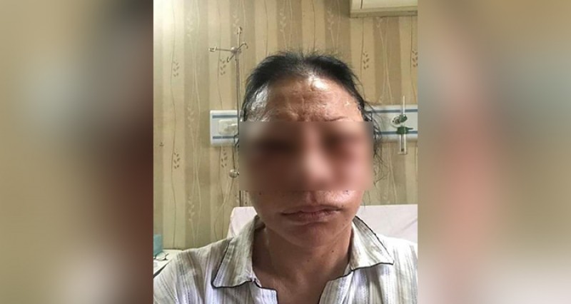 Ratna Sarumpaet sedot lemak di wajah.