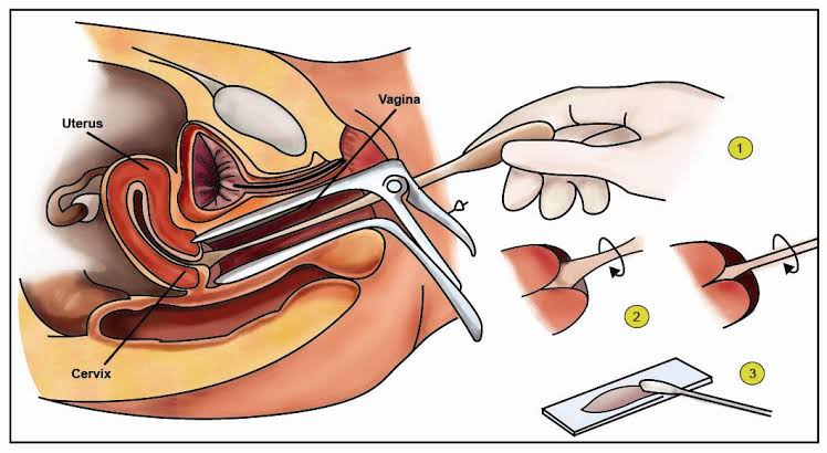 Ilustrasi Pap Smear