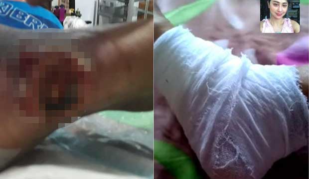 Kondisi kaki ayah Depe.