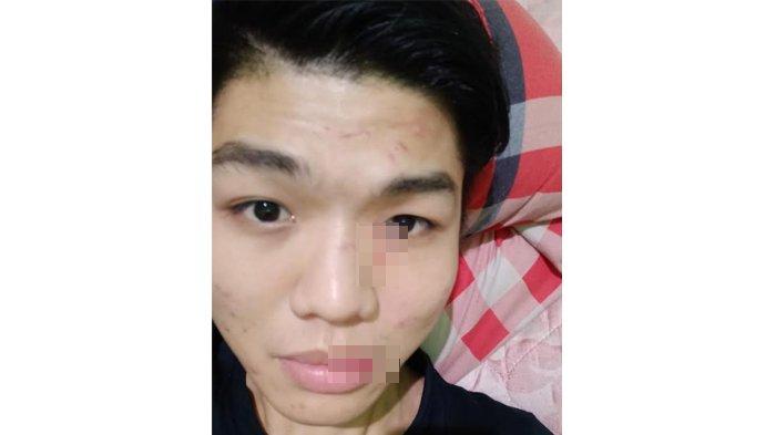 Hidung dan bibir Rian Lee jadi sasaran pemukulan.