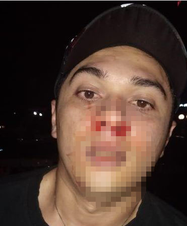 Antony Hillenaar memperlihatkan kondisi hidungnya yang berdarah, diduga akibat pemukulan Kriss Hatta.