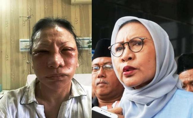 Ratna Sarumpaet kasus hoaks penganiayaan, padahal ia usai menjalani operasi wajah.