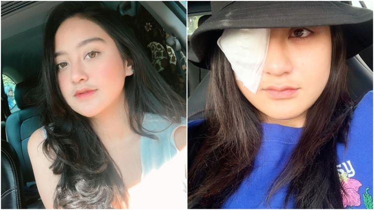 Salshabilla Adriani proses penyembuhan kerusakan kornea mata akibat softlens.