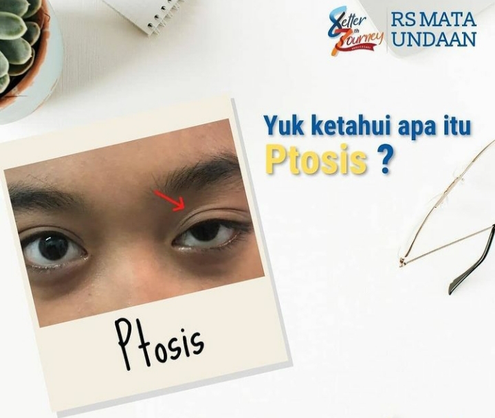 Ilustrasi kondisi ptosis. (Foto: dok. RSMU)