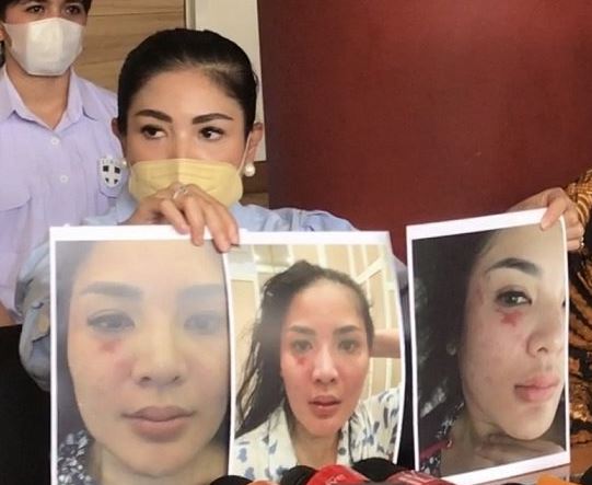 Penyanyi Nindy Ayunda memperlihatkan foto-foto wajahnya yang luka lebam akibat dipukul sang suami, Askara Parasady Harsono (Aska). (Foto: Istimewa)