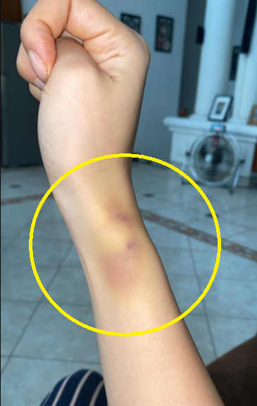 Foto lebam di tangan Frederika Alexis Cull bekas infus saat perawatan wajahnya. (Foto: Dok. Pribadi)