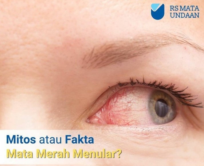 Ilustrasi mata merah, mitos, atau fakta bisa menular lewat pandangan. (Foto: Dok. RS Mata Undaan)