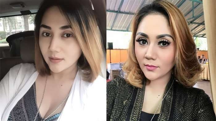 Aid Saskia mengungkap kondisinya usai operasi pengangkatan kanker payudara kanannya. (Foto: Instagram)