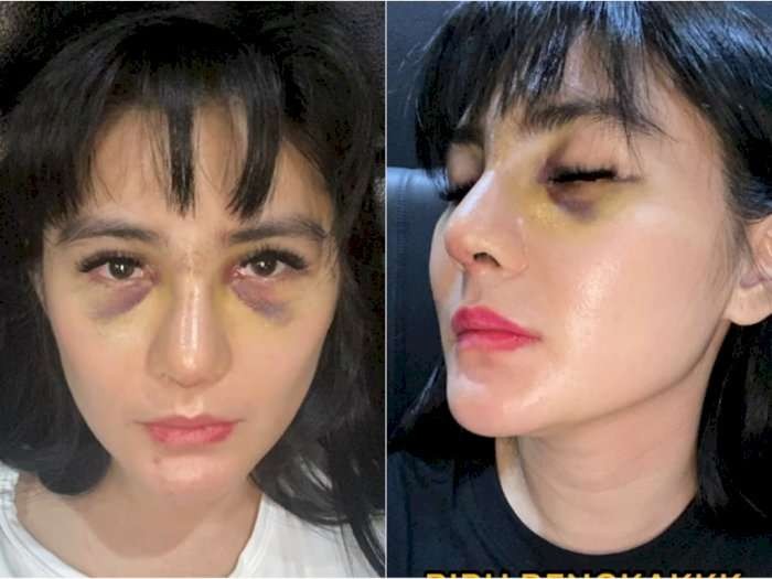 Wajah Angela Lee bengkak dan membiru usai endorse operasi hidung. (Foto: Instagram)