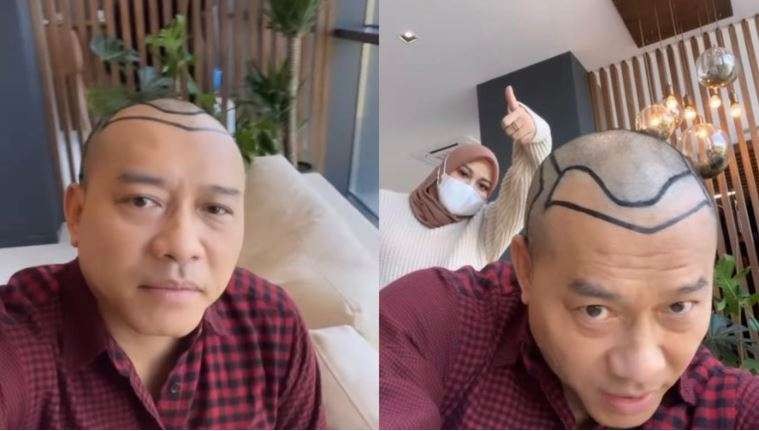 Musisi Anang Hermansyah transplantasi rambut di Turki. (Foto: Instagram)