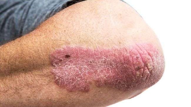 Ilustrasi penyebab dan gejala psoriasis yang membuat kulit bersisik dan mengelupas. (Foto: Istimewa)