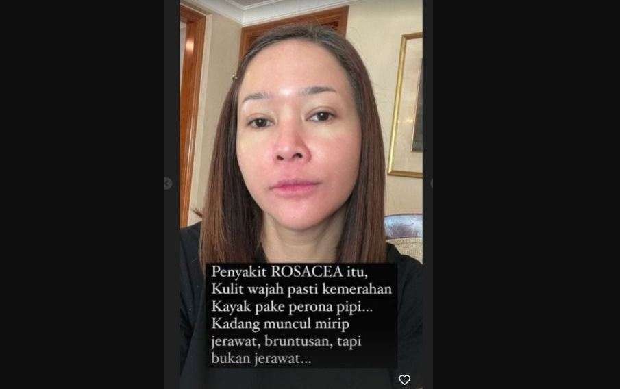 Kondisi wajah polos Maia Estianty tanpa make up tampak kemerahan. Wajahnya kemerahan di bagian pipi hingga bawah dagu. Ia mengidap rosacea. (Foto: Instagram Maia Estianty)