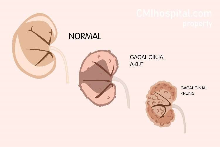 Ilustrasi kondisi ginjal (Foto: GMIhospital.com)