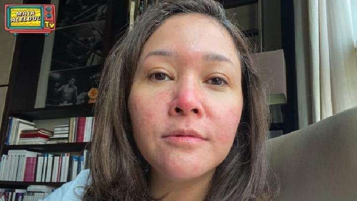 Wajah musisi sekaligus pengusaha Maia Estianty menderita rosacea. (Foto: YouTube MaiaAlElDul)