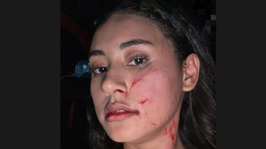 Wajah selebgram Afifah Riyad babak belur dicakar kreator konten Regi Nazlah, yang mengaku mantan pacar suaminya. (Foto: Instagram @afifahriyad)