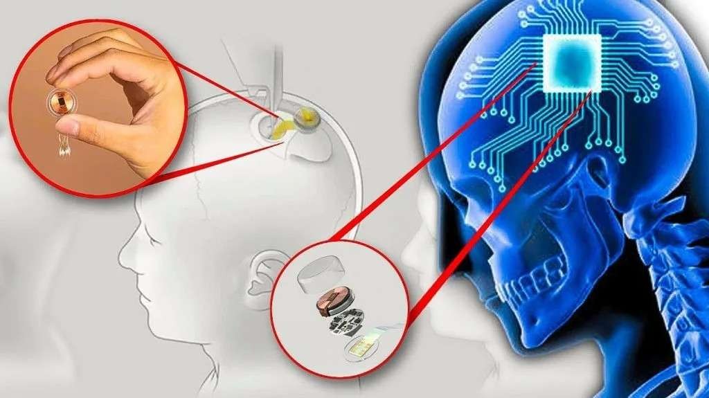 Elon Musk mengklaim berhasil menanamkan cip (chip) di otak manusia. (Foto: Ilustrasi)