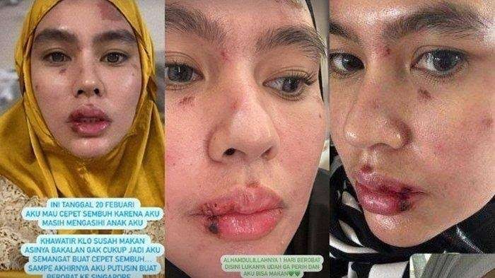 Kartika Putri sudah pulih kondisinya usai berobat di Singapura. Ia mengidap autoimun. (Foto: Insta story @kartikaputriworld)