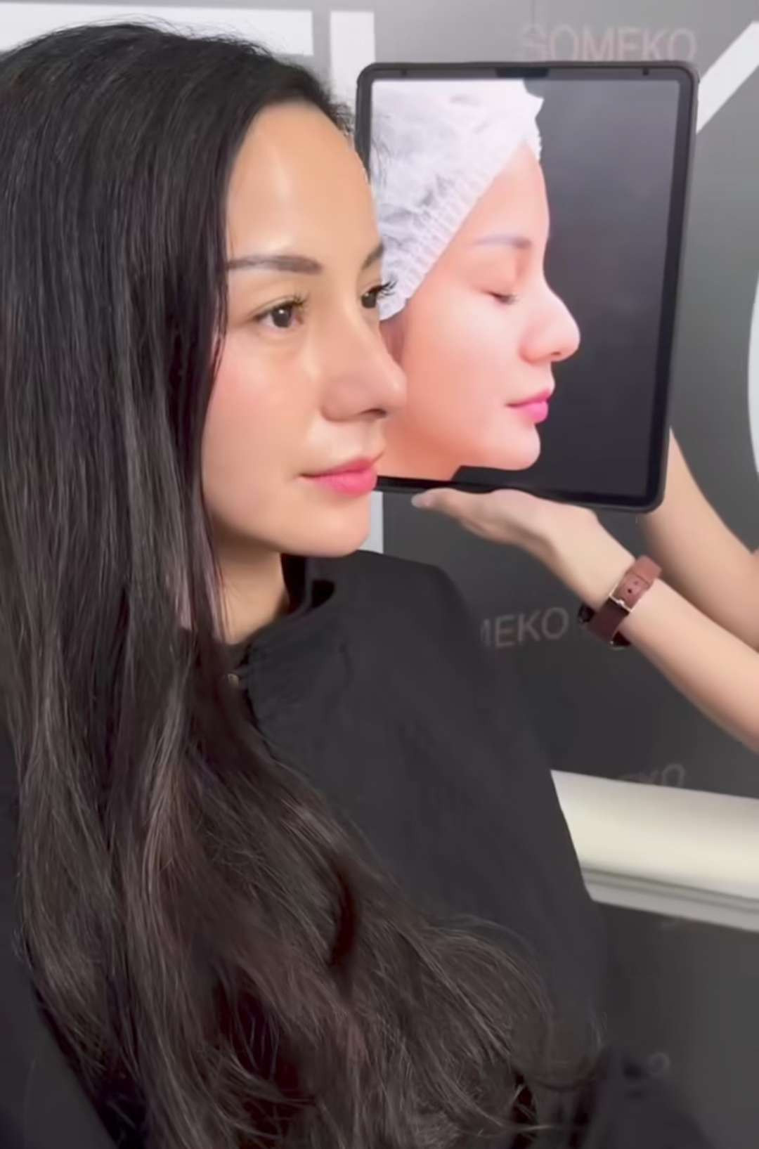 Kirana Larasati menyebut bentuk hidungnya sepeti betet sebelum disempurnakan melalui operasi. (Foto: Instagram)